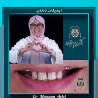 ایمپلنت دندان پزشکی / دندانپزشکی با رضایتمندی بالا