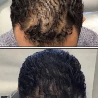 مسیر بازگشت تراکم مو