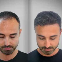 فیلر سی سی۳۳۰ بلفاروپلاستی ۶/۹۰۰ بوتاکس ۲۵۰|خدمات آرایشگری و زیبایی|تهران, صادقیه|دیوار