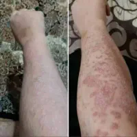 پیسی . پسوریازیس. اگزما. قارچ