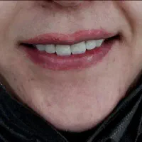 ساخت و ترمیم پروتز متحرک