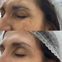 جشنواره بادی/فیلرصورت/ژل لب /جوانساز/ درگلشهر|خدمات زیبایی و سلامت|کرج, گلشهر|دیوار
