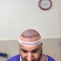 کاشت مو تضمینی