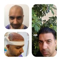 کاشت مو وابرو طبیعی تضمینی در تهران