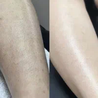 لیزر کل بدن (فول بادی)فقط۴۹۰تومن|خدمات آرایشگری و زیبایی|گنبد کاووس, |دیوار