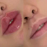جشنواره ویژه فیلر پی ارپی مزوبوتاکس با بهترین فرم