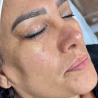 فیشال تخصصی زیر نظر پزشک|خدمات آرایشگری و زیبایی|مسجد سلیمان, |دیوار