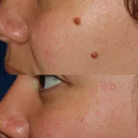 مرکز تخصصی برداشتن خال و زگیل ، اچ پی وی