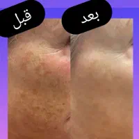 درمان لک درخانه|آرایشی، بهداشتی، درمانی|زرند, |دیوار