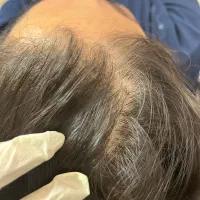 مزوتراپی مو مزونیدلینگ موفقط ۶۵۰ریزش مو رویش مجدد|خدمات آرایشگری و زیبایی|قائم‌شهر, |دیوار