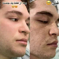 جشنوار یلدا درمان تضمینی کک ومک/لک/خال/فقط در1جلسه