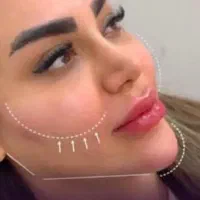 پکیج های ویژه تزریق ژل لیزر مادلینگ هایفو