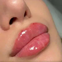 تزریق ژل فیلر بوتاکس مزوتراپی مو ابرو صورت پی آرپی|خدمات آرایشگری و زیبایی|اهواز, نادری|دیوار