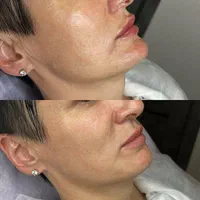 تخفیف ژل ،بوتاکس ،جوانساز،فیلر وفیشیال|خدمات آرایشگری و زیبایی|کرج, مهرویلا جنوبی|دیوار