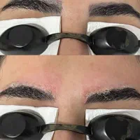 پاک کردن تتو