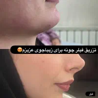 تزریق ژل لب،بوتاکس،مزو تراپی،هایفو تراپی،لیزر|خدمات آرایشگری و زیبایی|فردیس, شهرک ارم|دیوار