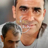 کاشت مو با بالاترین تراکم