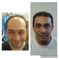 کاشت مو و ابرو با ضمانتنامه کتبی با ۸ ملیون تومان|خدمات آرایشگری و زیبایی|تهران, پاسداران|دیوار