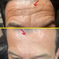 درمان چین و چروک و جوانسازی تضمینی