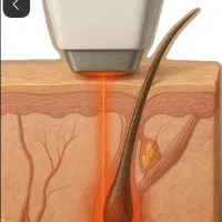 لیزر موهای زائد بانوان و آقایون