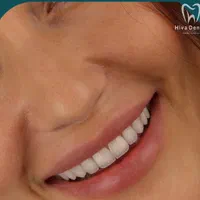 کامپوزیت زیبایی|خدمات آرایشگری و زیبایی|تهران, دزاشیب|دیوار