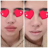 جشنواره بوتاکس مصپورت ۶۵۰فیلر ۶۹۰ فقط تا آخر آبان|خدمات آرایشگری و زیبایی|اصفهان, شمس آباد|دیوار