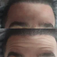 آف خدمات زیبایی ژل وبوتاکس(خانم ها و آقایان)