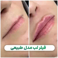 مدل فیلر بوتاکس