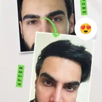 کاشت مو بصورت کاملاً تخصصی