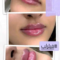 لیزر لاغری تزریق فیلر و بوتاکس پی آرپی