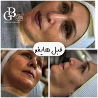 فیشیال.کربن.لیزر.لاغری.هایفو|خدمات آرایشگری و زیبایی|کرج, کوی زنبق|دیوار