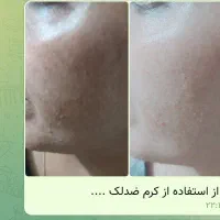 کرم جوانسازی و ضد لک|آرایشی، بهداشتی، درمانی|گرگان, |دیوار