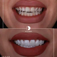کامپوزیت دندان.لمینت|خدمات آرایشگری و زیبایی|مشهد, کوثر|دیوار
