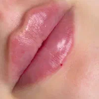 تزریق ژل وفیلر|خدمات آرایشگری و زیبایی|رباطکریم, رباطکریم|دیوار