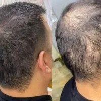 کاشت به دردت نمیخوره