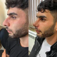 جشنواره عمل بینی فقط با ۲۵ میلیون|خدمات آرایشگری و زیبایی|رشت, رشتیان|دیوار