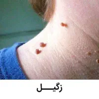 برداشتن زگیل و میخچه در یک جلسه|خدمات آرایشگری و زیبایی|قم, نیروگاه|دیوار
