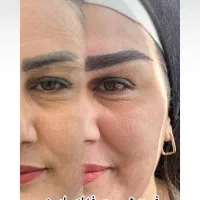 تخفیف ویژه تابستانی میکروکاشت ابرو و مو