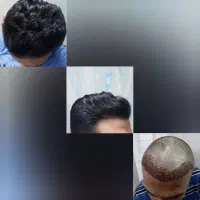 کاشت موی حرفه ای ،زیبایی در نهایت ظرافت