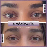 تخفیفات ۵۵٪ دکتر ملائی ،مزو بوتاکس فیلر ژل لب روسی|خدمات آرایشگری و زیبایی|مشهد, کوثر|دیوار