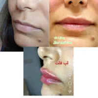 فیلرلب طبیعی