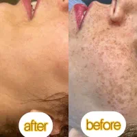 با یک جلسه کک و مکا حذف کن