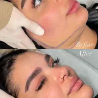 لیپو ساکشن غبغب متدی وی لاین تزریق چربی بوکال فت