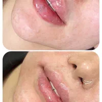 فیلر لب فقط ۱۸۰۰