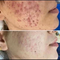 آموزش،فیشیال،پاکسازی تخصصی،جوانسازی صورت بانوان|خدمات آرایشگری و زیبایی|کرمانشاه, |دیوار