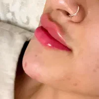 تزریق ژل و بوتاکس،فیلر بدن و لیفت با نخ