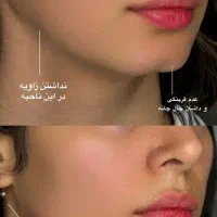 تزریق ژل لب بوتاکس مزو نخ آنزیم لیفت پکیج۱۰ سی سی|خدمات آرایشگری و زیبایی|تهران, مرزداران|دیوار