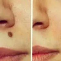 برداشتن خال وزگیل وکک ولک فقط بانوان|خدمات آرایشگری و زیبایی|دورود, |دیوار