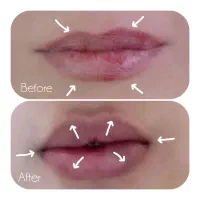 خدمات تزریق ژل و بوتاکس، خال برداری|خدمات آرایشگری و زیبایی|شیراز, حجت آباد|دیوار