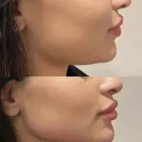 تزریق تخصصی ژل و بوتاکس|خدمات آرایشگری و زیبایی|سبزوار, کوی بهار|دیوار